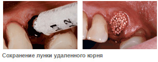 Сохранение лунки удаленного корня при использовании Easy-Graft